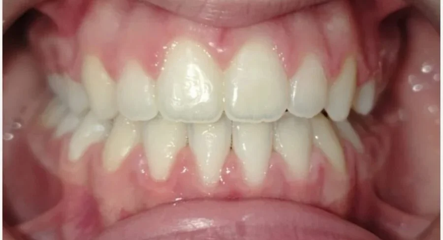 Orthodontics — After