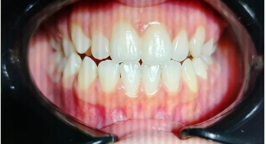 Orthodontics — Before