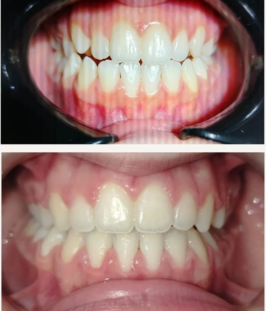 Teeth before and after orthodontic treatment