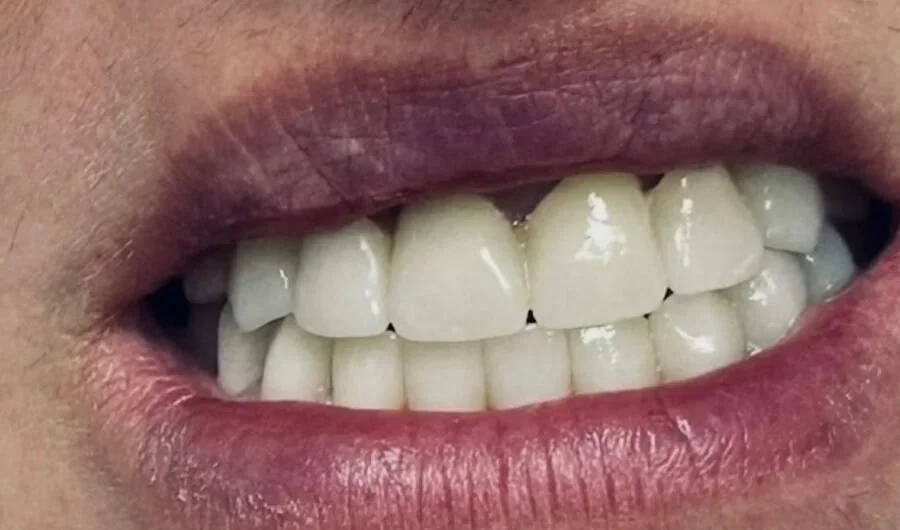 Prosthodontics — After