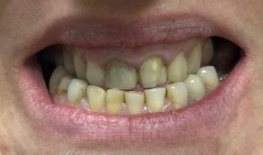 Prosthodontics — Before