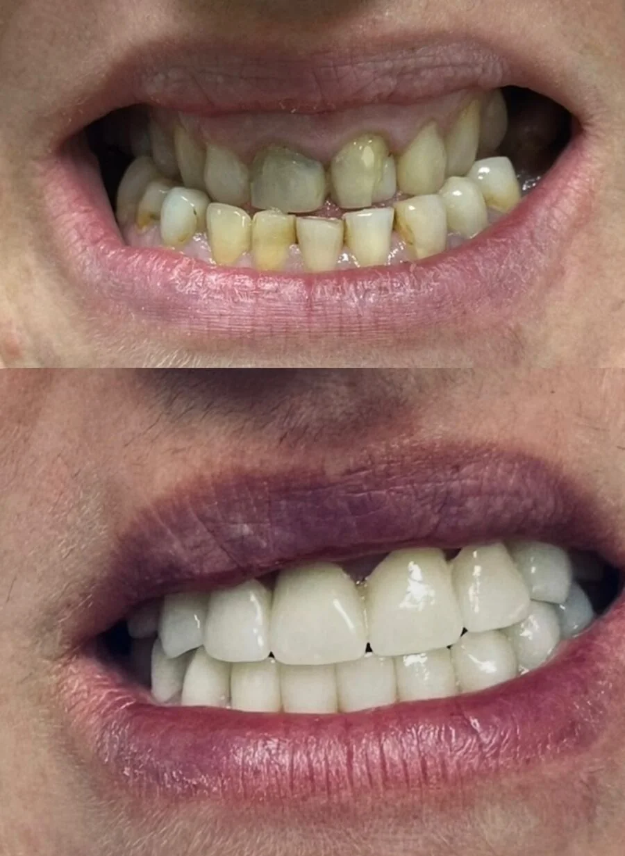 Upper and lower teeth before and after prosthodontic treatment