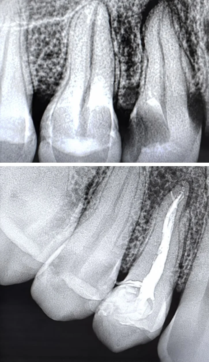 Radiograph of a tooth before and after root canal treatment
