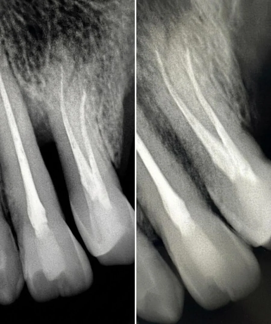 Radiograph following root canal treatment
