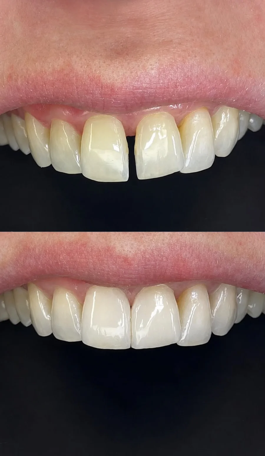 Upper front teeth before and after treatment