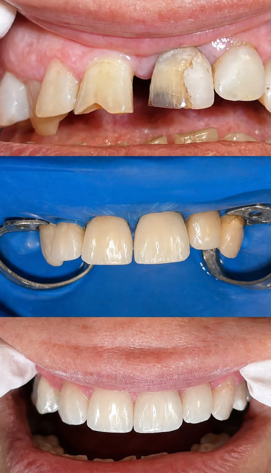 Upper front teeth before, during and after treatment