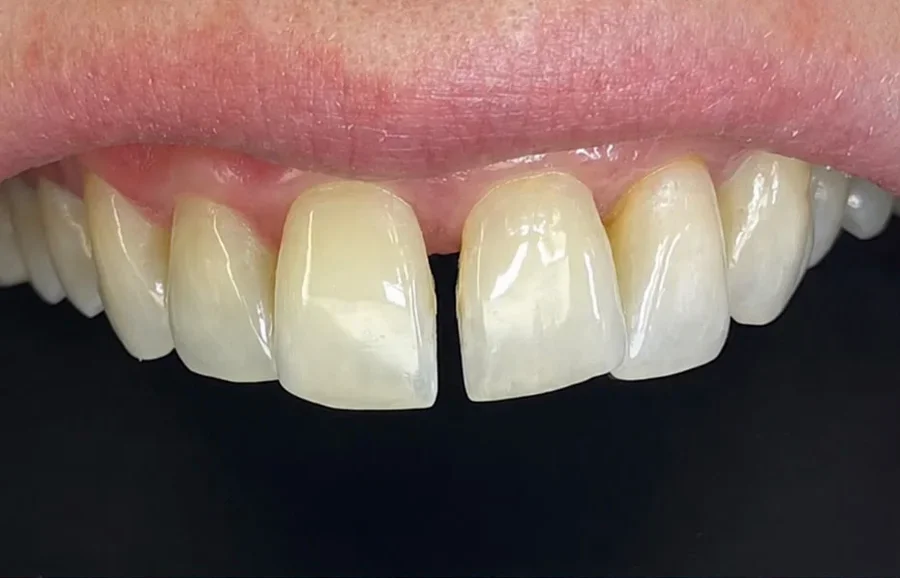 Therapeutic dentistry — Before