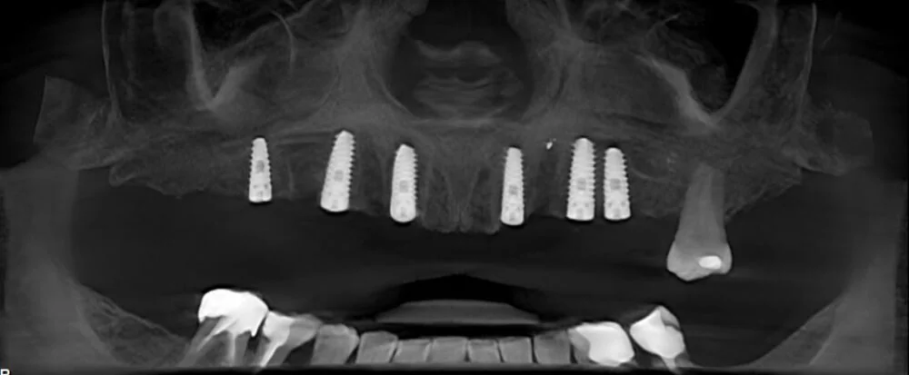 Panoramic radiograph showing six dental implants in the upper jaw