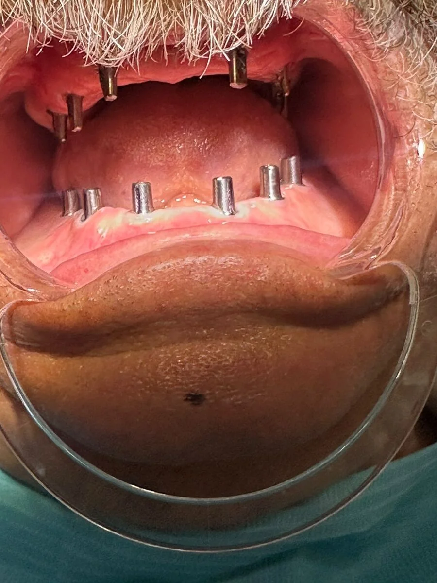 Placed dental implants at the healing stage