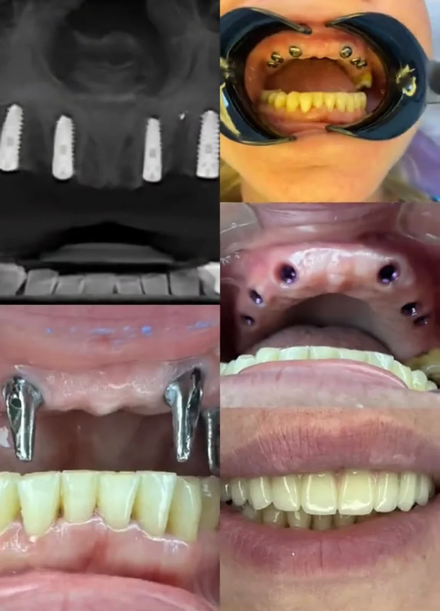 Dental implants, from the radiograph to the finished teeth
