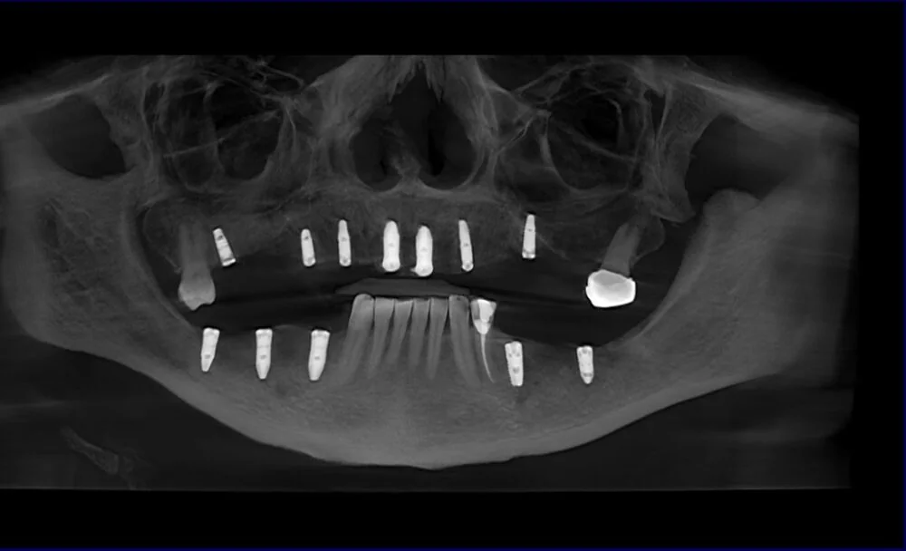 Panoramic radiograph showing dental implants in both jaws