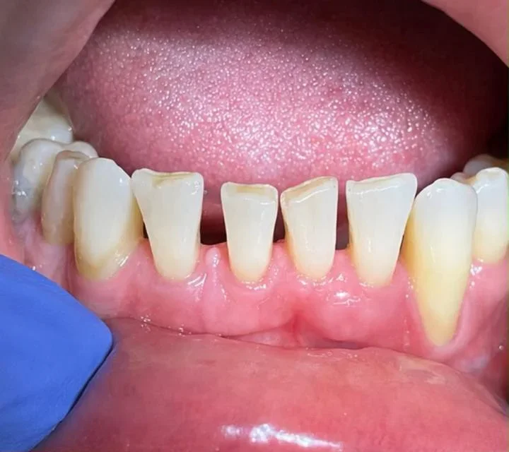 Therapeutic dentistry — Before