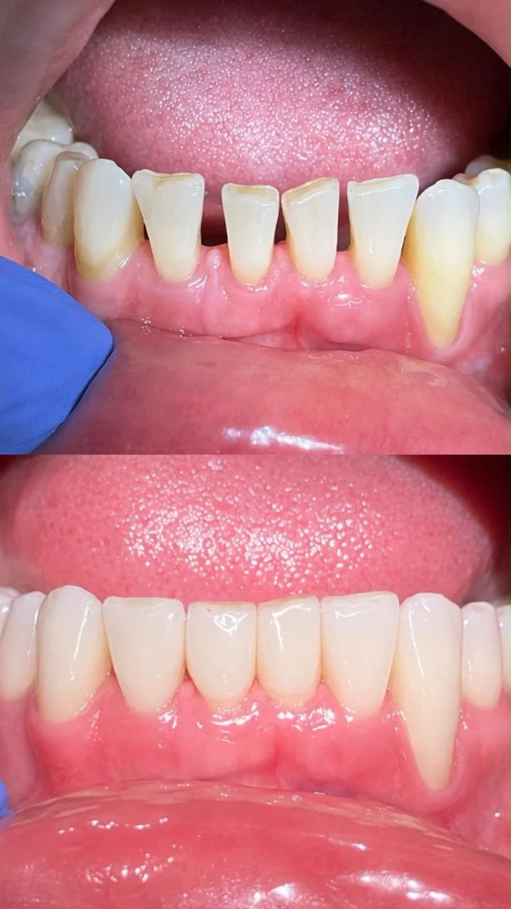Lower front teeth before and after treatment