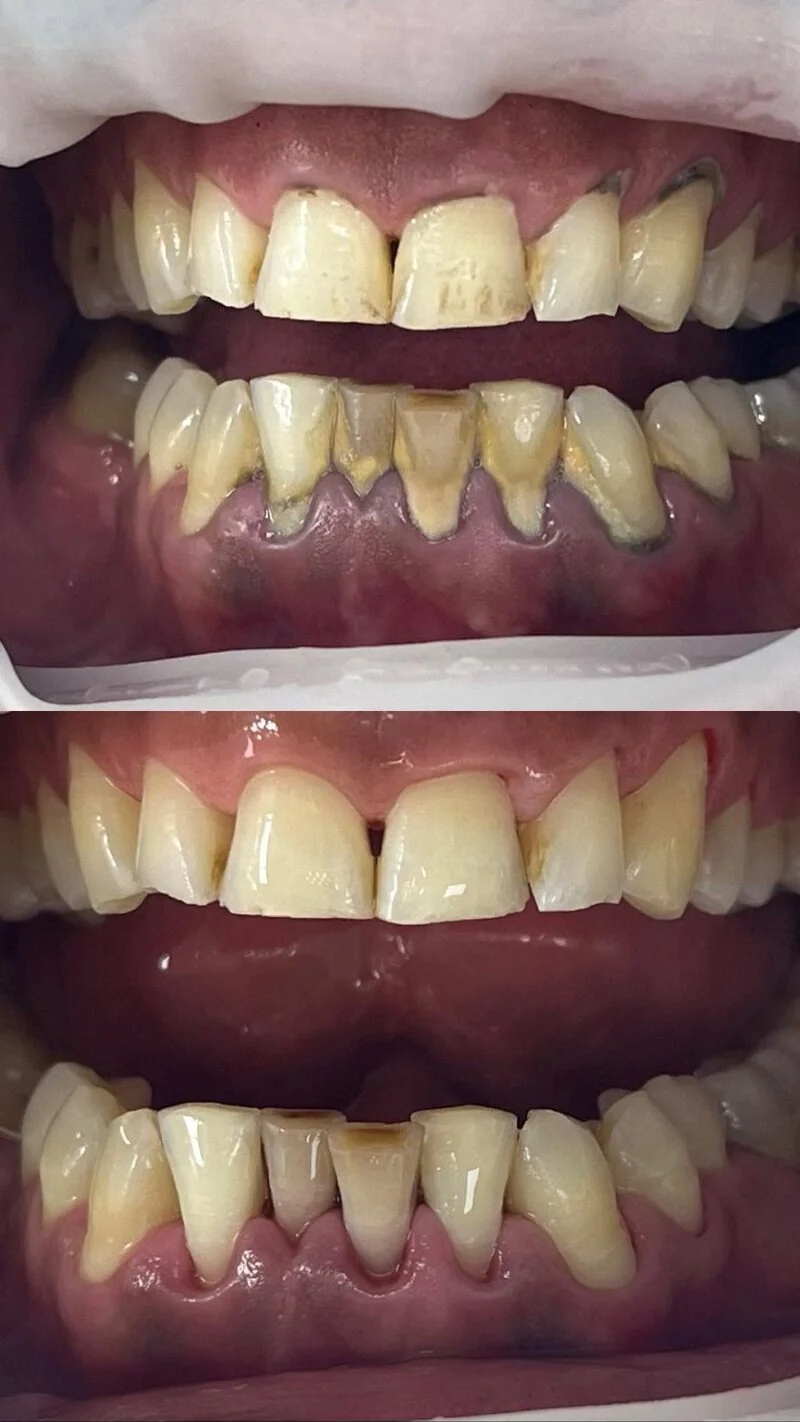 Gums and teeth before and after periodontal treatment