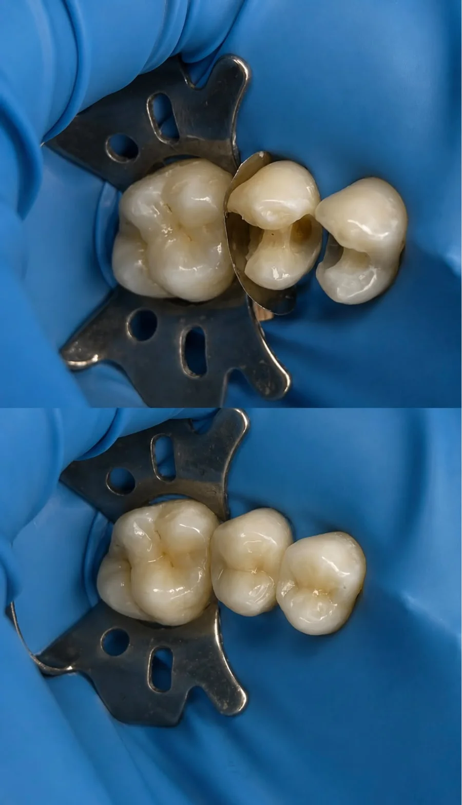 Back teeth before and after treatment
