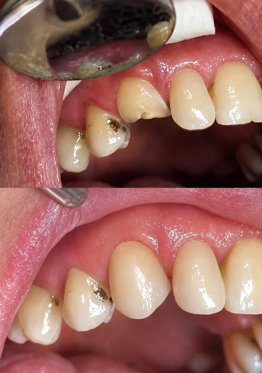 Upper side teeth before and after treatment