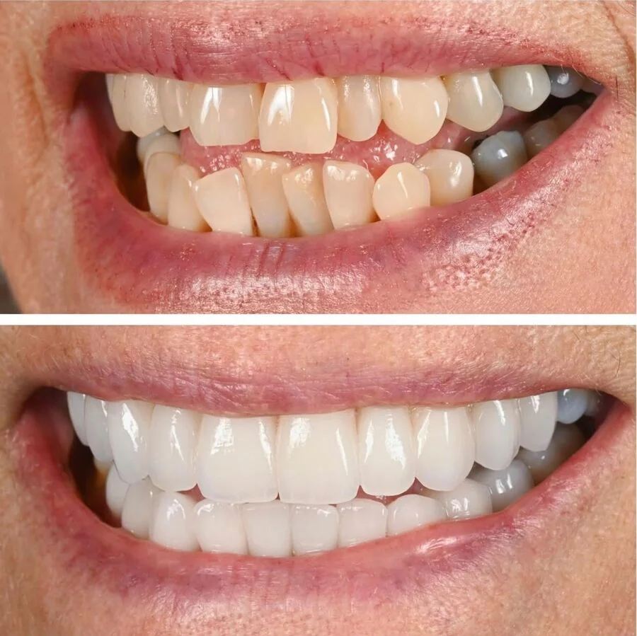 Teeth before and after prosthodontic treatment
