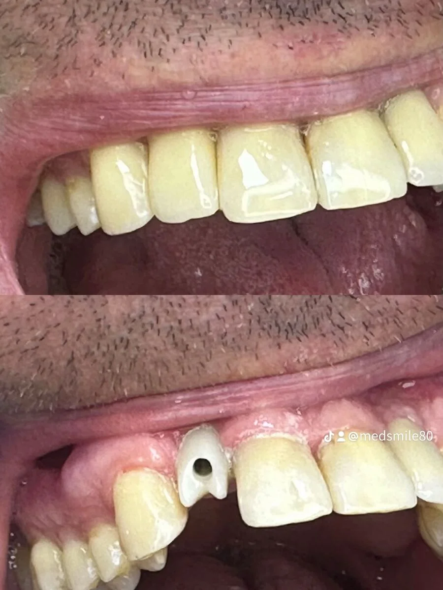 Upper jaw prosthetic work, before and after