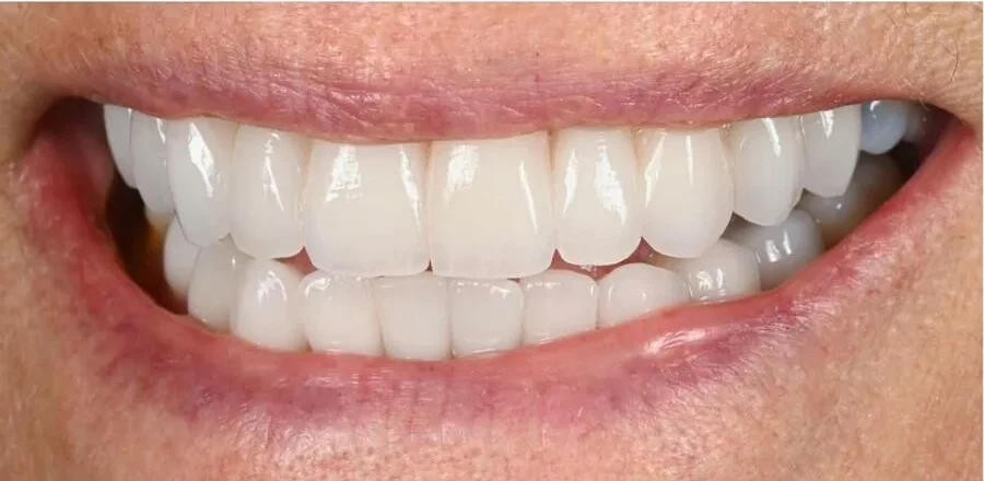 Prosthodontics — After