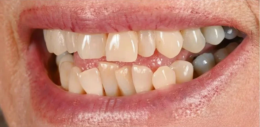 Prosthodontics — Before