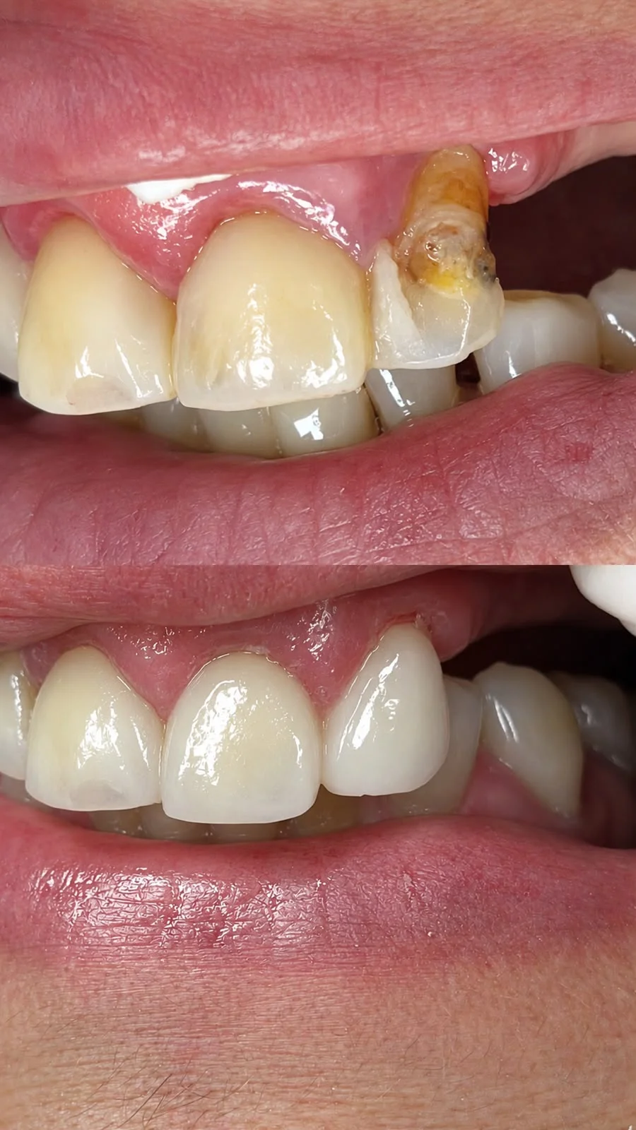 Front teeth before and after therapeutic restoration