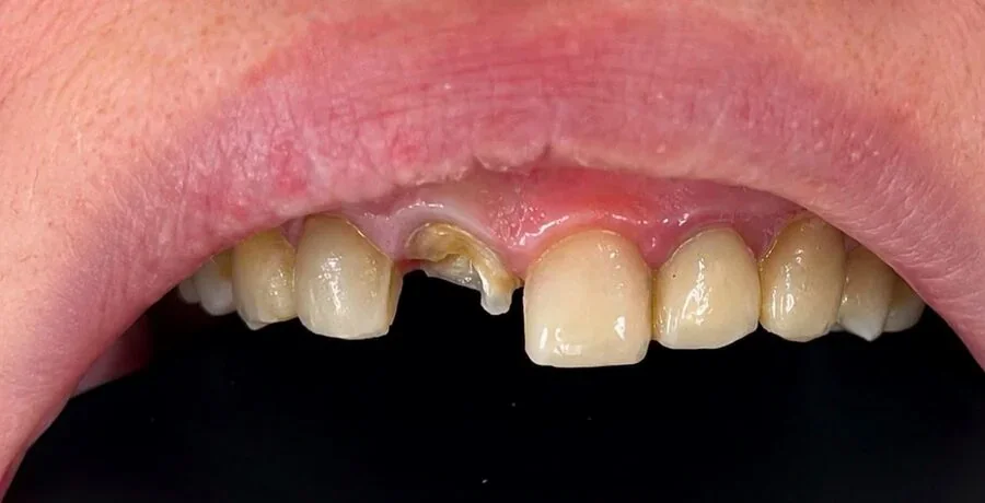 Therapeutic dentistry — Before