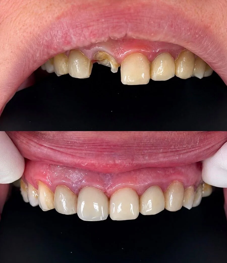 A front tooth before and after therapeutic restoration