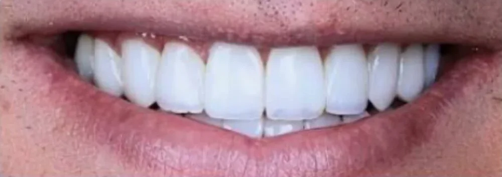 Prosthodontics — After