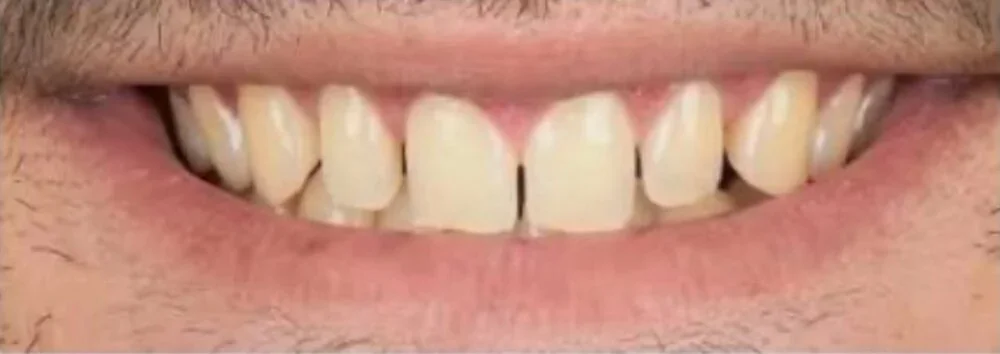 Prosthodontics — Before
