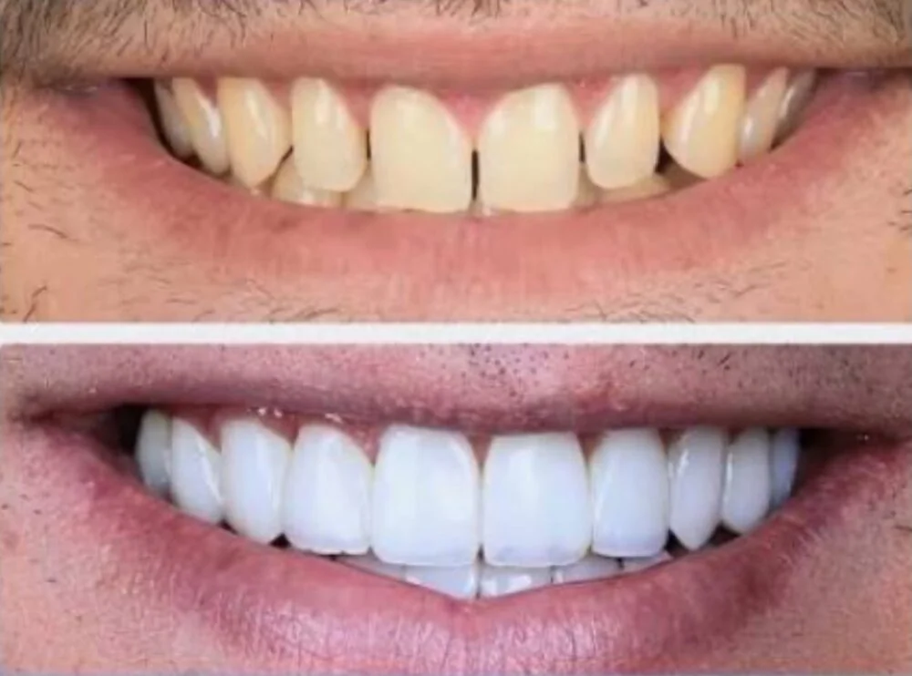 Upper front teeth before and after prosthodontic treatment